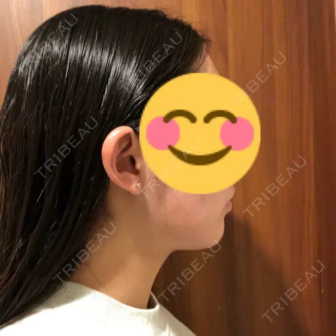 脂肪吸引（顔） THE CLINIC（ザ・クリニック） 東京院 DAY 90 メイン用