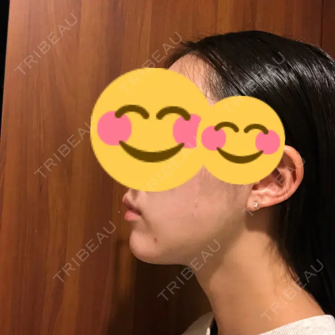 脂肪吸引（顔） THE CLINIC（ザ・クリニック） 東京院 DAY 90 メイン用