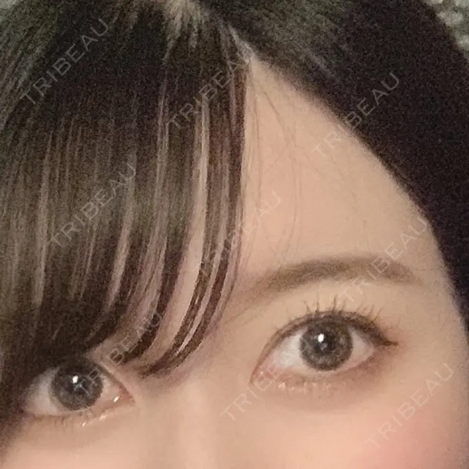 二重切開 / 目頭切開 心斎橋コムロ美容外科クリニック AFTER メイン用