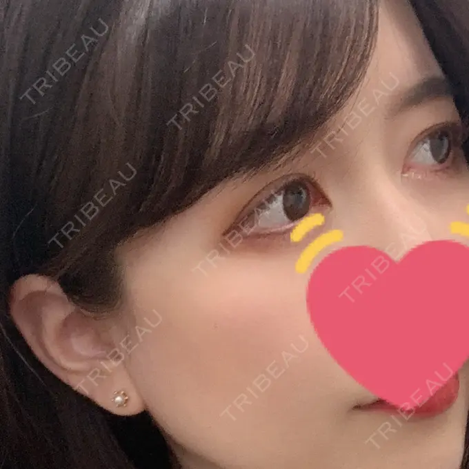 二重切開 / 目頭切開 心斎橋コムロ美容外科クリニック DAY 426 メイン用