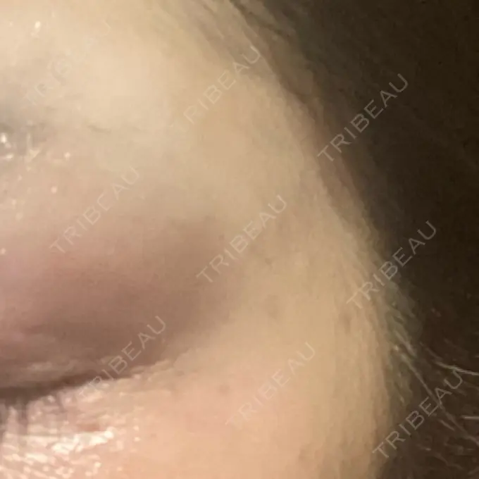 ボトックス（目尻） TCB東京中央美容外科 千葉駅前院 DAY 4 メイン用