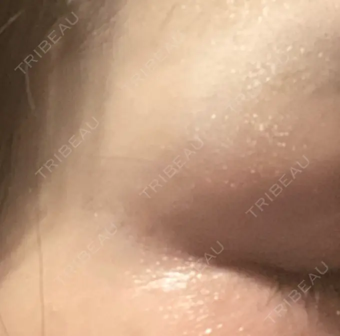 ボトックス（目尻） TCB東京中央美容外科 千葉駅前院 DAY 6 メイン用