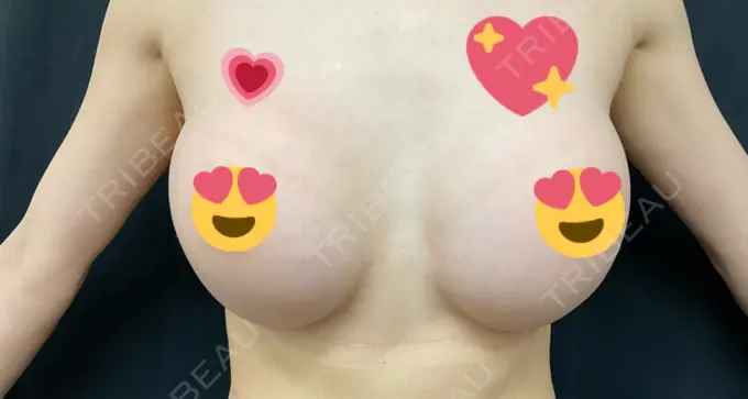 豊胸（シリコンバッグ） ジョウクリニック 大阪院 DAY 149 メイン用