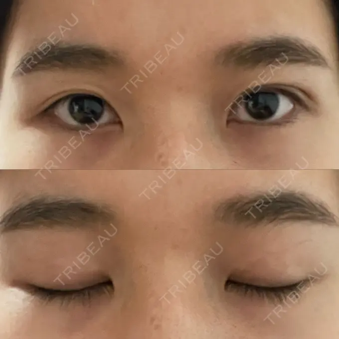 二重埋没 湘南美容クリニック 赤坂見附院 AFTER メイン用