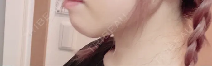 あごプロテーゼ 新宿TAクリニック DAY 4 メイン用