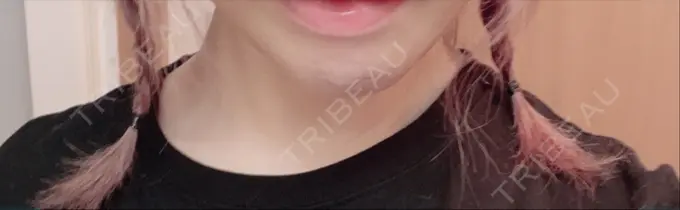 あごプロテーゼ 新宿TAクリニック DAY 4 メイン用