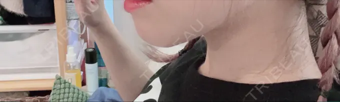 あごプロテーゼ 新宿TAクリニック DAY 18 メイン用