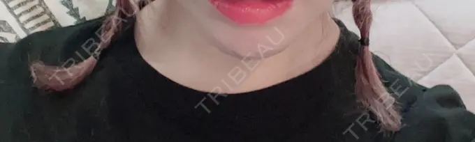 あごプロテーゼ 新宿TAクリニック DAY 18 メイン用