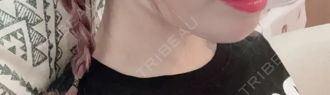 あごプロテーゼ 新宿TAクリニック DAY 18 メイン用