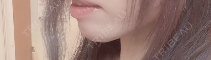 あごプロテーゼ 新宿TAクリニック AFTER メイン用