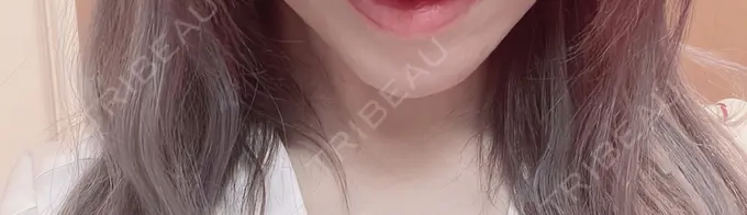 あごプロテーゼ 新宿TAクリニック DAY 162 メイン用