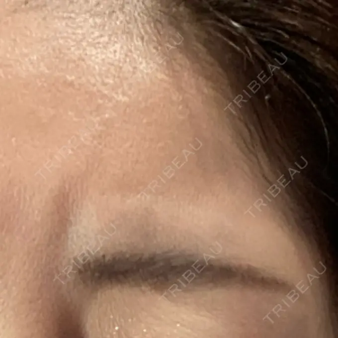 ボトックス（額） TCB東京中央美容外科 千葉駅前院 DAY 4 メイン用