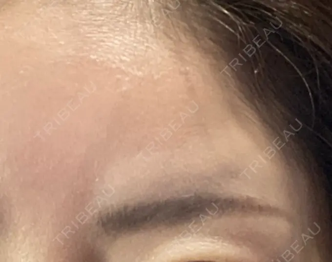 ボトックス（額） TCB東京中央美容外科 千葉駅前院 DAY 5 メイン用