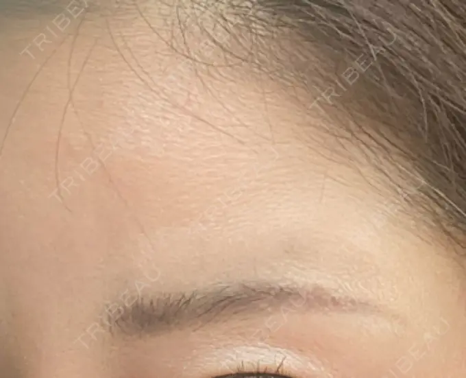 ボトックス（額） TCB東京中央美容外科 千葉駅前院 DAY 6 メイン用