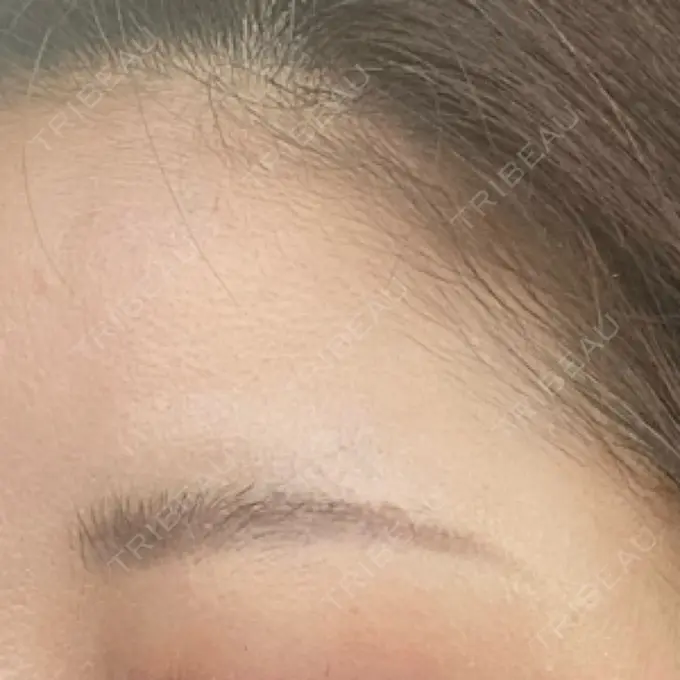 ボトックス（額） TCB東京中央美容外科 千葉駅前院 DAY 7 メイン用