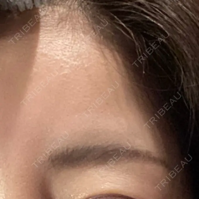 ボトックス（額） TCB東京中央美容外科 千葉駅前院 DAY 8 メイン用