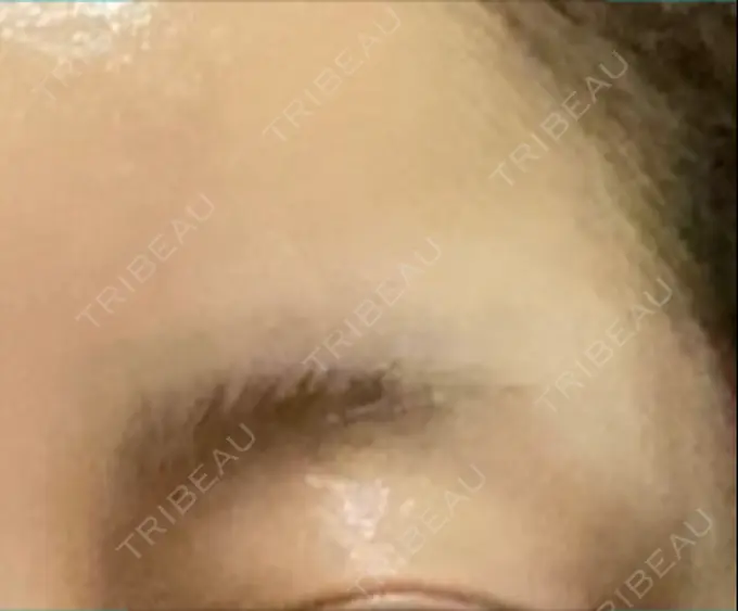 ボトックス（額） TCB東京中央美容外科 千葉駅前院 DAY 9 メイン用