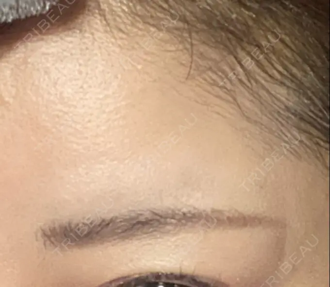 ボトックス（額） TCB東京中央美容外科 千葉駅前院 DAY 10 メイン用