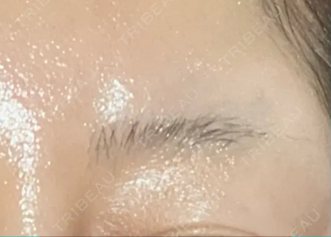 ボトックス（額） TCB東京中央美容外科 千葉駅前院 DAY 11 メイン用