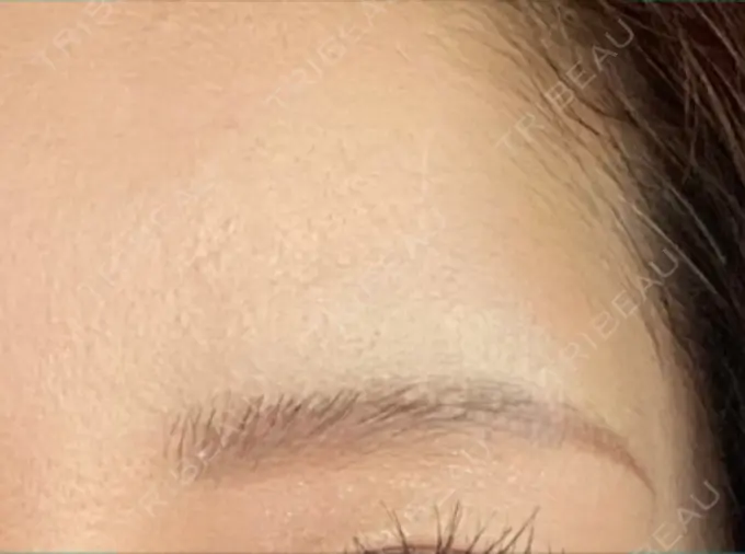 ボトックス（額） TCB東京中央美容外科 千葉駅前院 AFTER メイン用