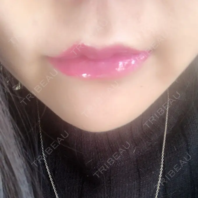 口唇縮小術 品川美容外科池袋院 DAY 22 メイン用