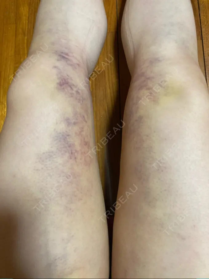 脂肪吸引（脚） / 脂肪吸引（お腹） / 豊胸（脂肪注入） THE CLINIC（ザ・クリニック） 名古屋院 DAY 6 メイン用