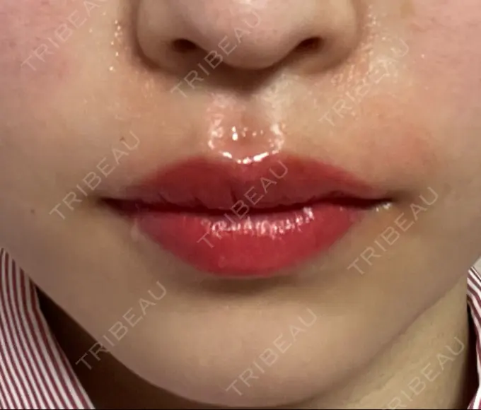 アートメイク（唇） 筋肉・美容クリニック DAY 0 メイン用