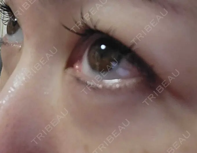 下まぶたたるみ取り / 下まぶたの脂肪取り 品川スキンクリニック広島院 DAY 24 メイン用