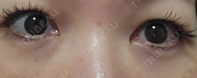 下まぶたたるみ取り / 下まぶたの脂肪取り 品川スキンクリニック広島院 DAY 24 メイン用