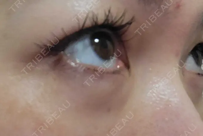 下まぶたたるみ取り / 下まぶたの脂肪取り 品川スキンクリニック広島院 DAY 24 メイン用