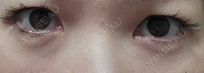 下まぶたたるみ取り / 下まぶたの脂肪取り 品川スキンクリニック広島院 DAY 27 メイン用