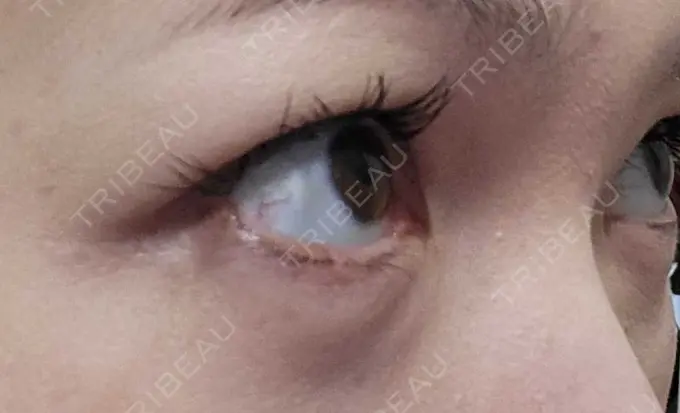 下まぶたたるみ取り / 下まぶたの脂肪取り 品川スキンクリニック広島院 DAY 27 メイン用