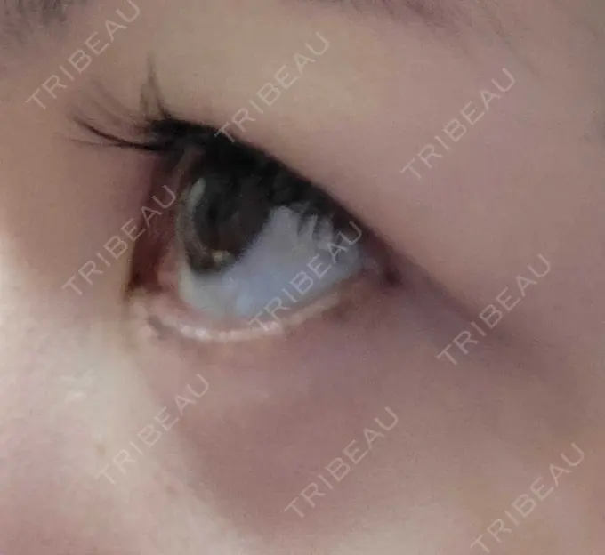 下まぶたたるみ取り / 下まぶたの脂肪取り 品川スキンクリニック広島院 DAY 27 メイン用