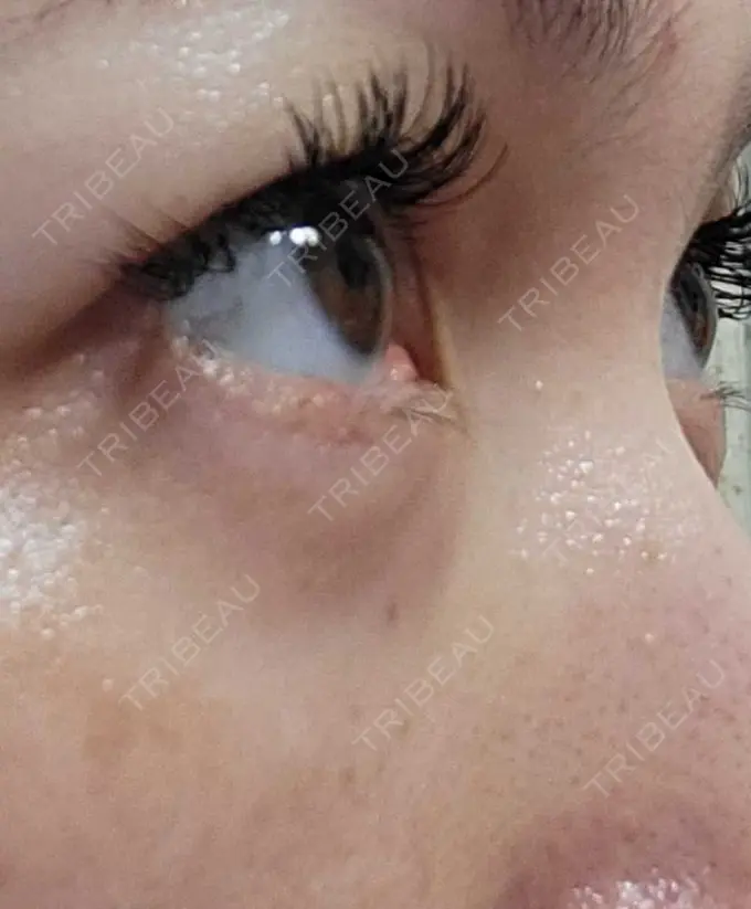 下まぶたたるみ取り / 下まぶたの脂肪取り 品川スキンクリニック広島院 DAY 32 メイン用