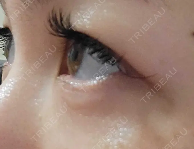 下まぶたたるみ取り / 下まぶたの脂肪取り 品川スキンクリニック広島院 DAY 32 メイン用