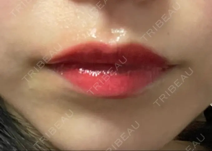 アートメイク（唇） 筋肉・美容クリニック DAY 1 メイン用