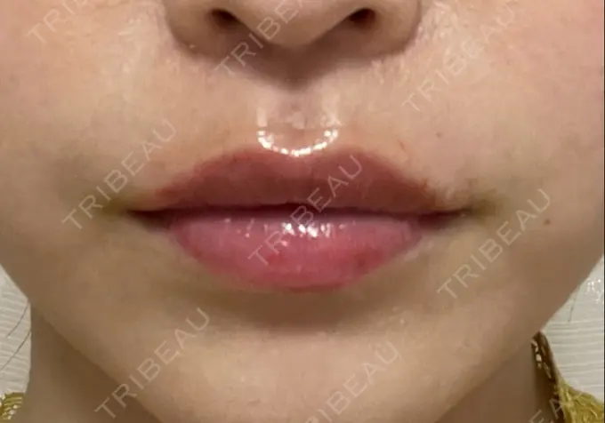 アートメイク（唇） 筋肉・美容クリニック DAY 2 メイン用