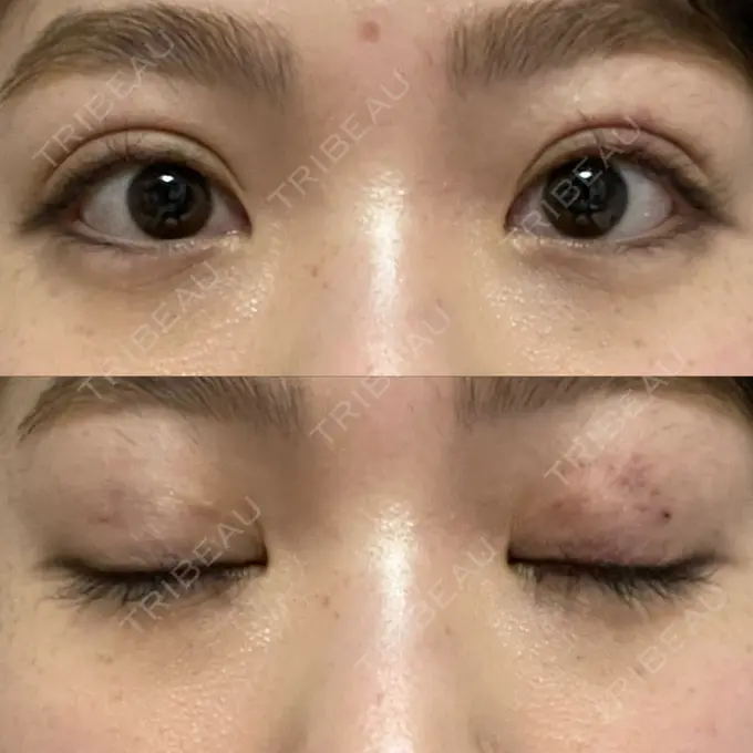 二重埋没 / シワ取りボトックス ルラ美容クリニック 渋谷本院 DAY 4 メイン用