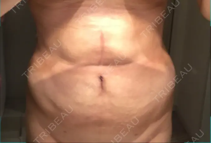 脂肪吸引（お腹） / インディバ（お腹） 藤・ナチュレ美容クリニック 恵比寿院 DAY 92 メイン用