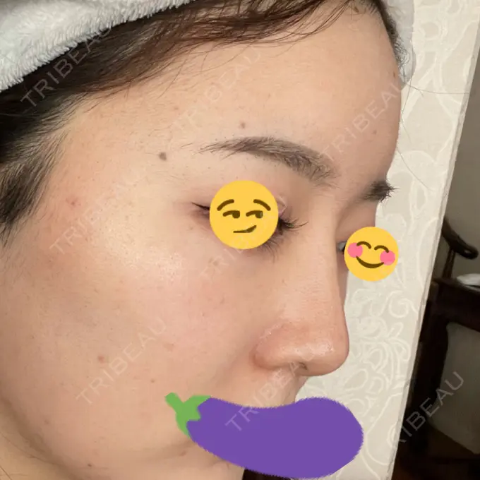 隆鼻術 ヤスミクリニック DAY 30 メイン用