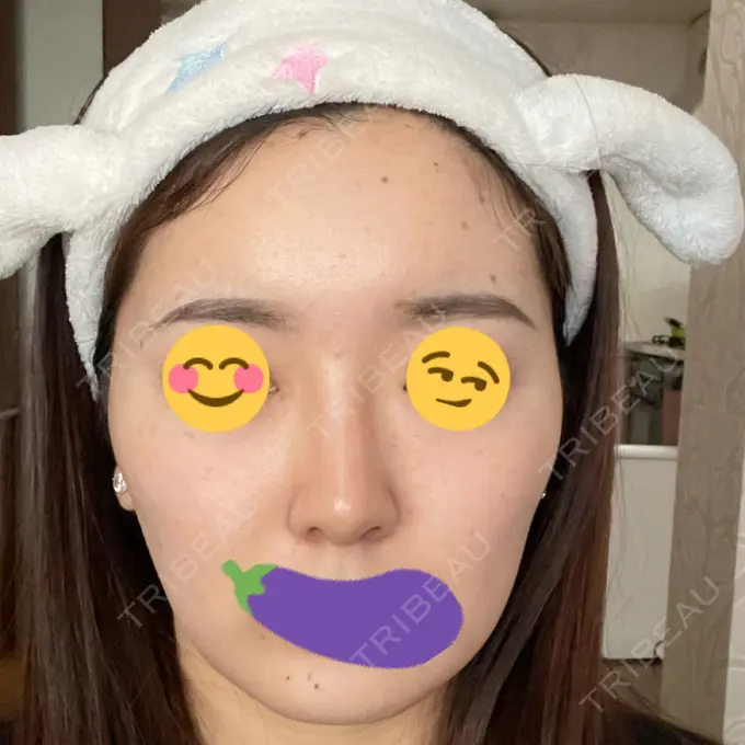 隆鼻術 ヤスミクリニック DAY 30 メイン用