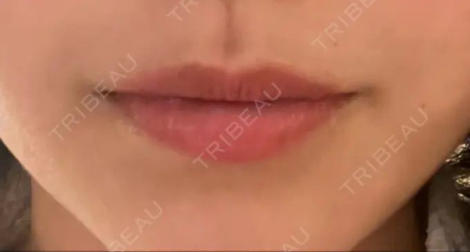 アートメイク（唇） 筋肉・美容クリニック DAY 3 メイン用