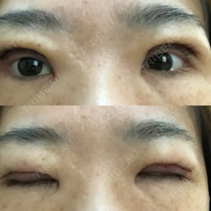 眼瞼下垂（切開） 滋賀美容皮膚科クリニック DAY 1 メイン用