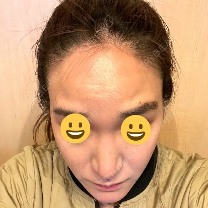 マイクロボトックス / ボトックス（額） / その他（輪郭） ルラ美容クリニック 新宿院 DAY 0 メイン用