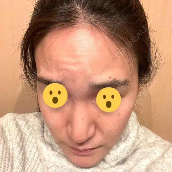 マイクロボトックス / ボトックス（額） / その他（輪郭） ルラ美容クリニック 新宿院 DAY 1 メイン用