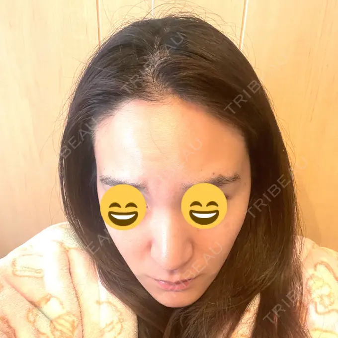 マイクロボトックス / ボトックス（額） / その他（輪郭） ルラ美容クリニック 新宿院 DAY 2 メイン用