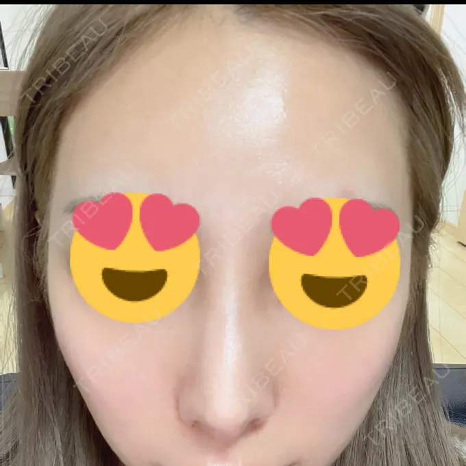 イオン導入 / レーザートーニング（美白・肝斑） / ピーリング（ハリ・ツヤ） 新宿美容外科クリニック 立川院 DAY 18 メイン用