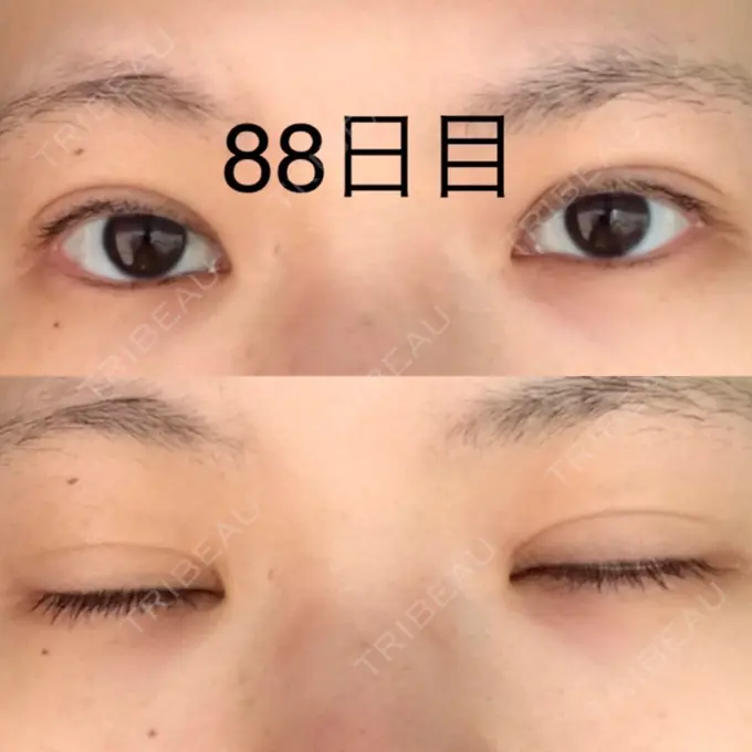 二重切開 / 上まぶたたるみ取り / 上まぶたの脂肪取り 城本クリニック 豊橋院 DAY 88 メイン用