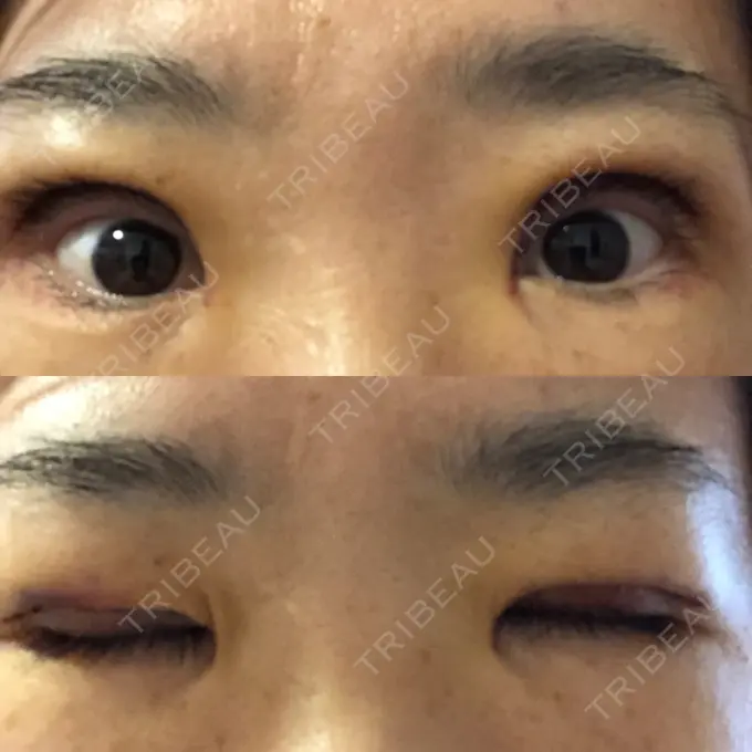 眼瞼下垂（切開） 滋賀美容皮膚科クリニック DAY 3 メイン用