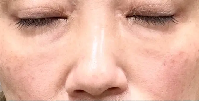 レーザートーニング（美白・肝斑） 銀座美容外科クリニック 銀座院 DAY 0 メイン用